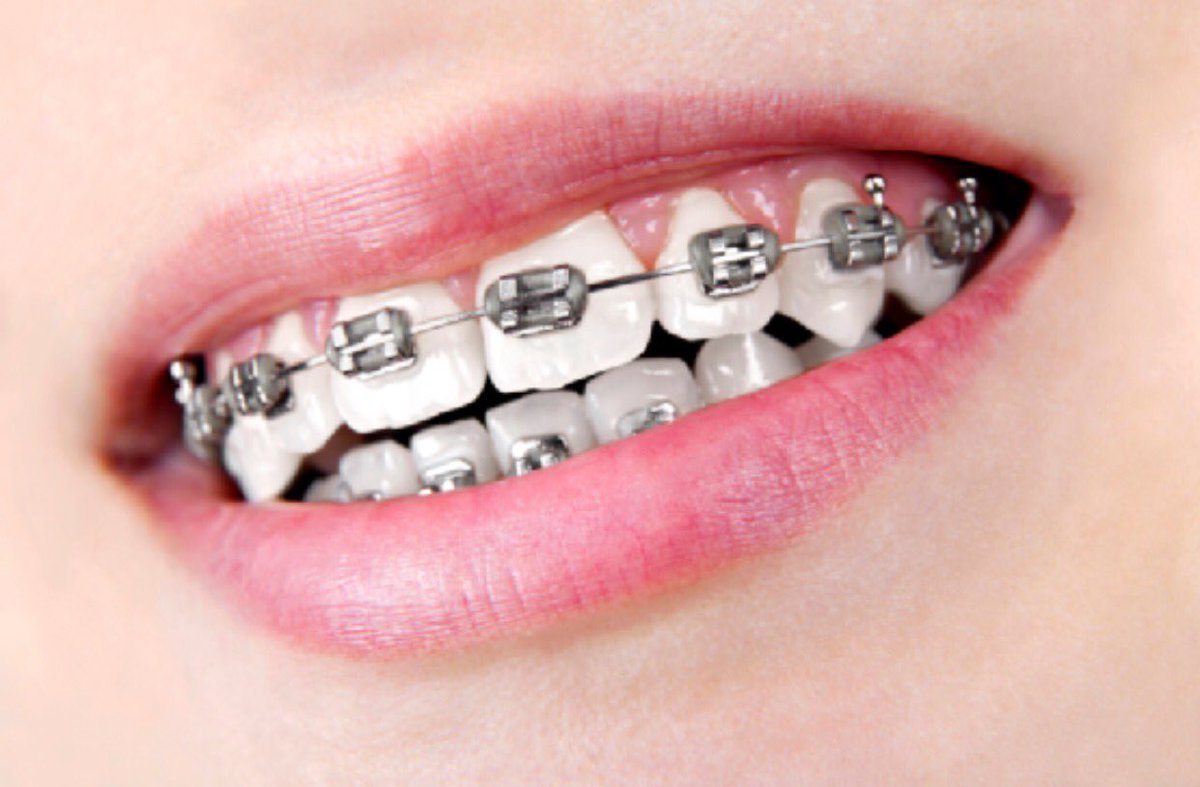 خطوات تركيب تقويم الاسنان العادي