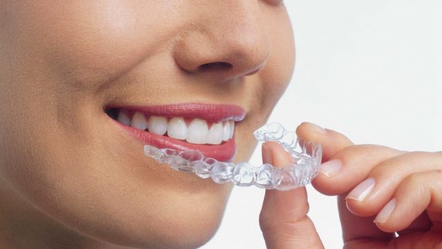 شكل تقويم الأسنان الشفاف
