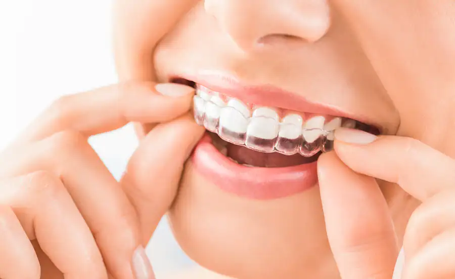 شكل تقويم الأسنان الشفاف