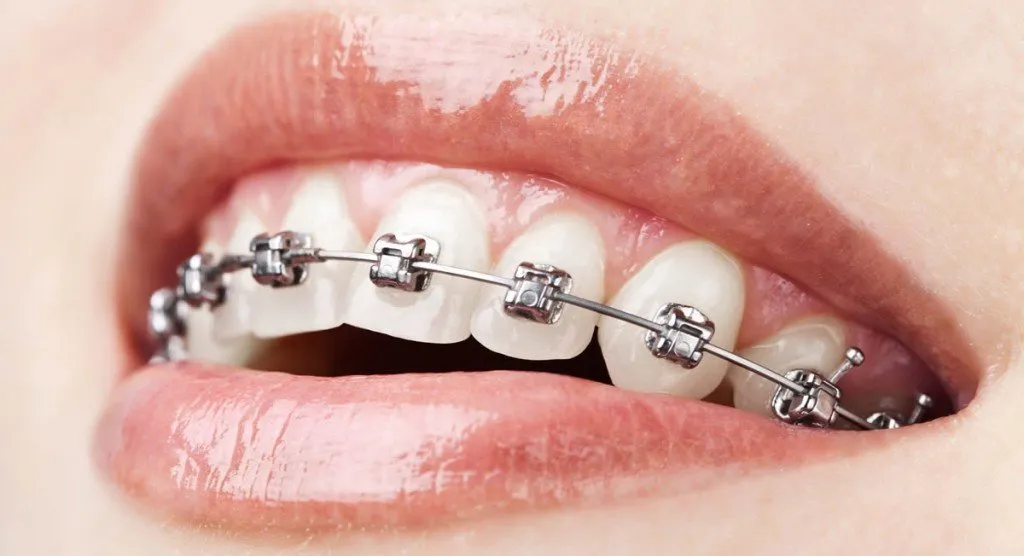 كم من الوقت يستغرق علاج تقويم الأسنان؟
