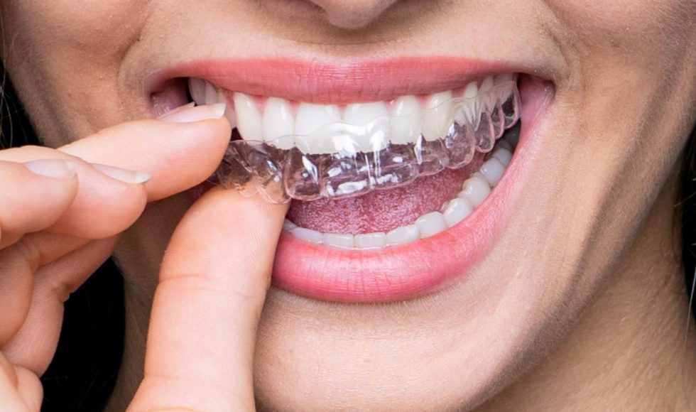 كيفية تركيب تقويم الأسنان الشفاف