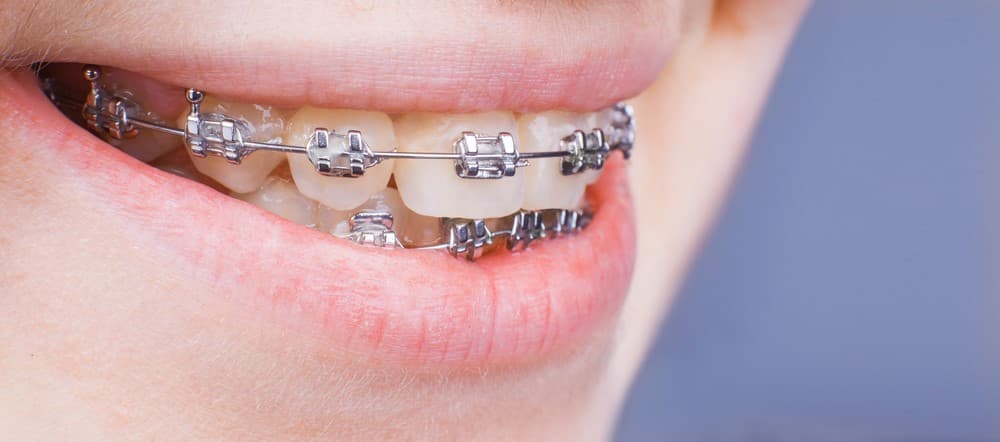ما هي عوامل تباين تكلفة تقويم الأسنان؟