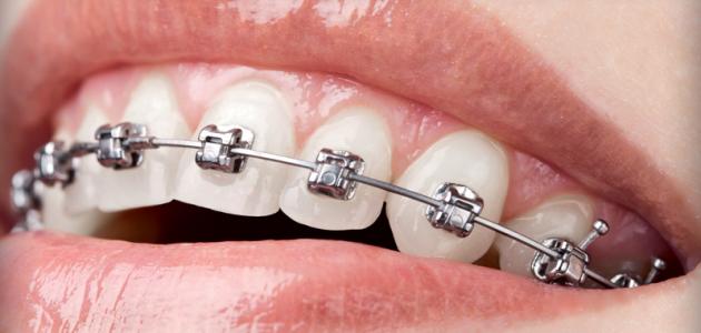 ما هي عيوب تقويم الأسنان ؟