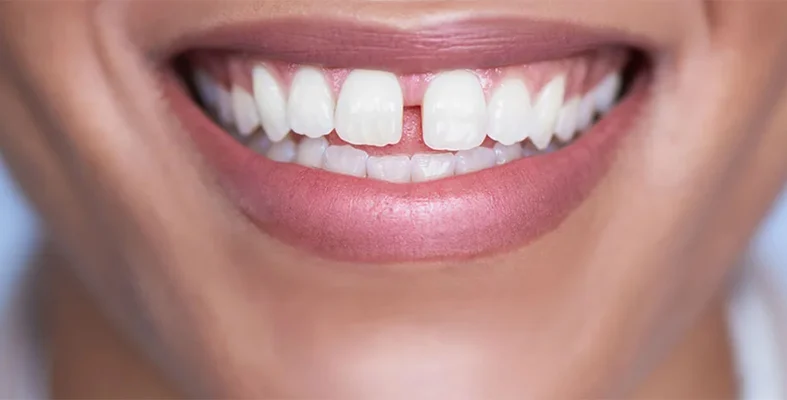 متى يجب مراجعة أخصائي تقويم الأسنان للعلاج فلج الأسنان؟