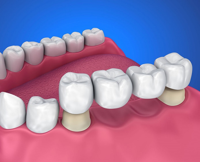 مضاعفات تركيبات الأسنان