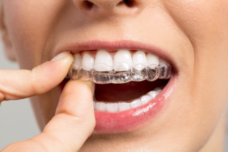مميزات تقويم الاسنان الشفاف المتحرك