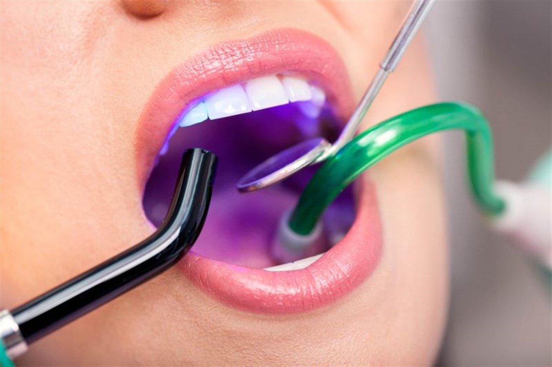 نصائح عند تركيب تقويم الأسنان بالليزر