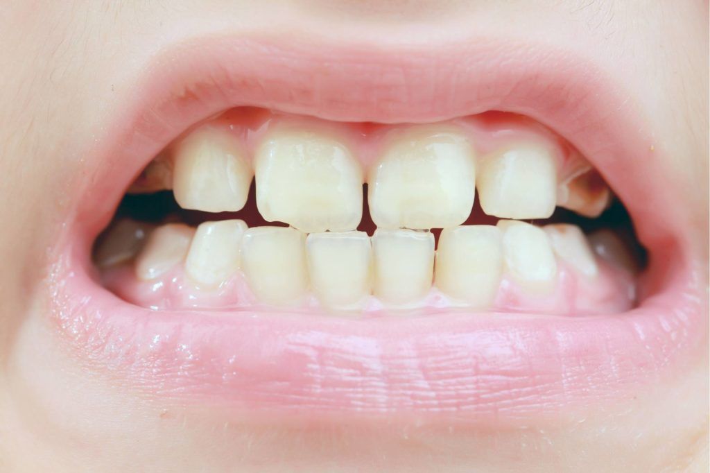 هل يتم برد الاسنان بعد تقويمها؟
