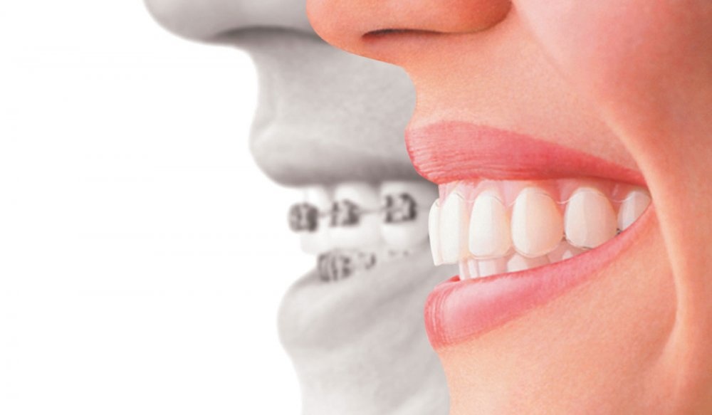 هل يمكنك علاج الاسنان المتضررة سابقا خلال فترة التقويم؟