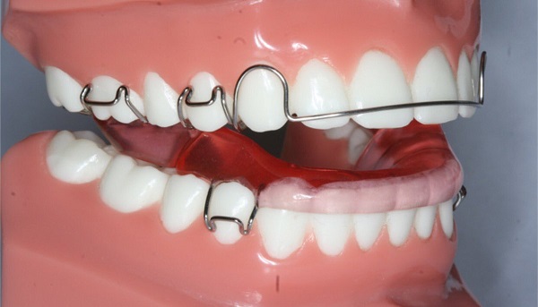 ما هو حديد تقويم الاسنان واسباب استخدامه؟