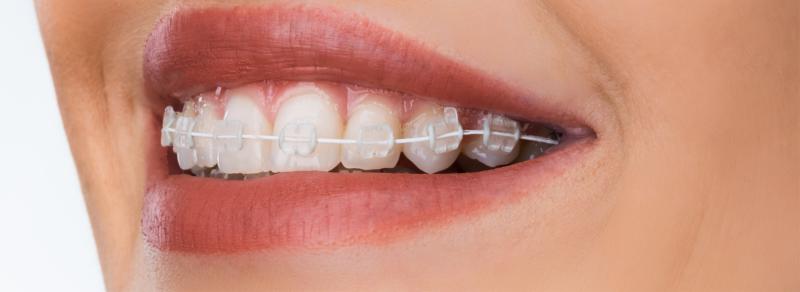 كيفية تركيب تقويم الأسنان المخفي