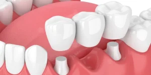 ما هي تكلفة تركيب جسر الاسنان وما هي العوامل المؤثرة عليها