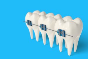 معلومات عن جهاز التقويم الاسنان ومتي يلزم تركيبه؟