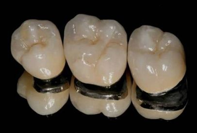 مراحل عملية تركيب الاسنان الثابتة