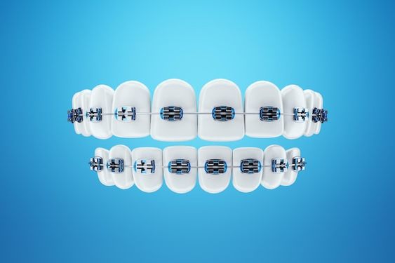 التقنية المستخدمة في تقويم الأسنان