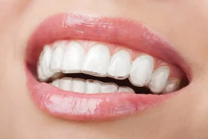 اكتشف ما هو تقويم الأسنان المتحرك للكبار وطريقة تركيبه