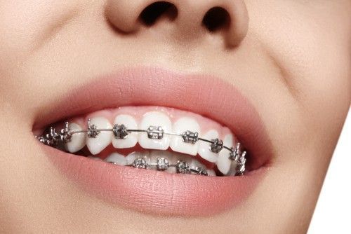 عيوب تقويم اسنان طبي