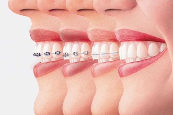 متى يحتاج الإنسان إلى تقويم الاسنان؟