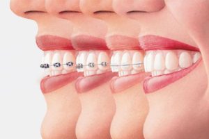 اكتشف أكثر عن تخفيضات تقويم الاسنان وأهم المراكز التي تقدمها1