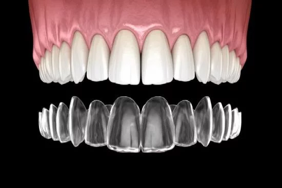 استكشف معنا أهمية عمل تقويم اسنان متحرك شفاف والعمر المناسب لتركيبه!