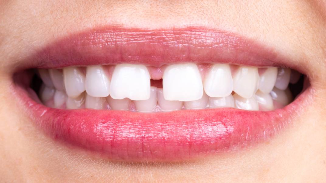 أسباب ظهور فراغات الاسنان