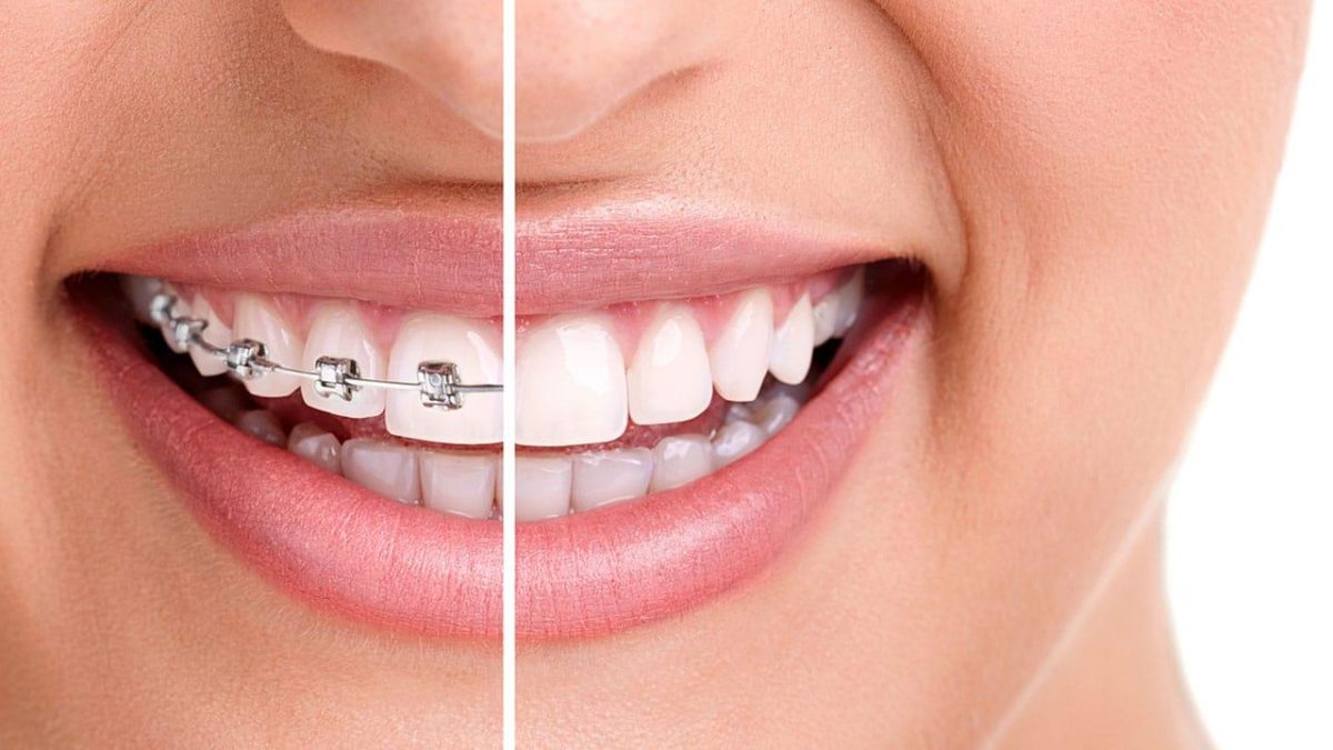  أنواع تقويم الأسنان