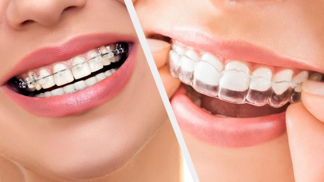 أنواع تقويمات الاسنان الغير مرئي