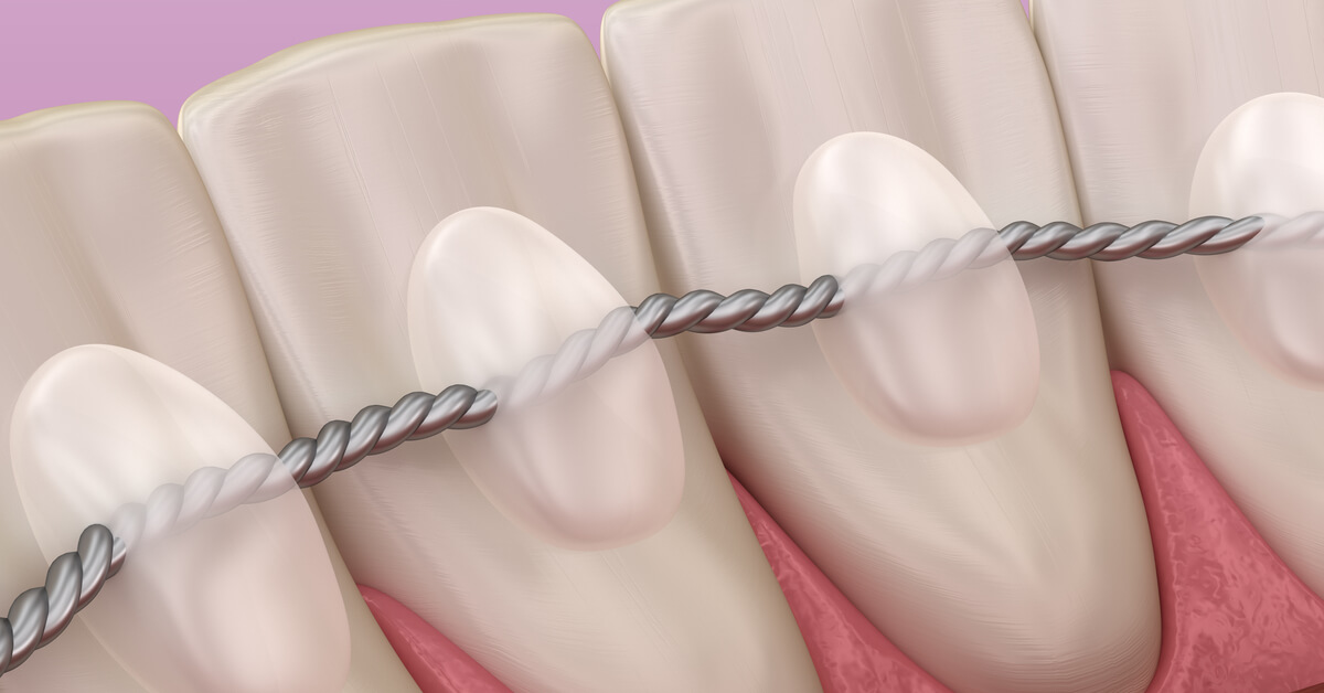 أنواع مثبت الاسنان بعد التقويم