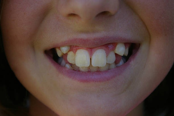 اعراض بروز الاسنان الامامية