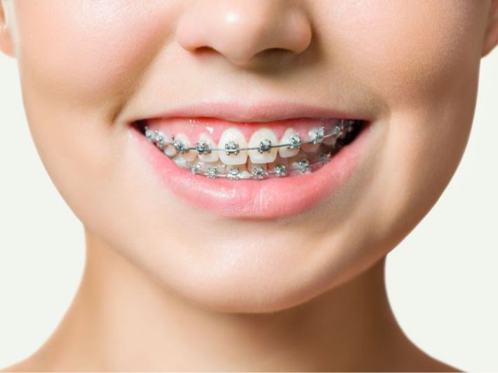احصل على أسنان أفضل مع التقويم المعدني للاسنان وتعرف على خطوات تركيبه!