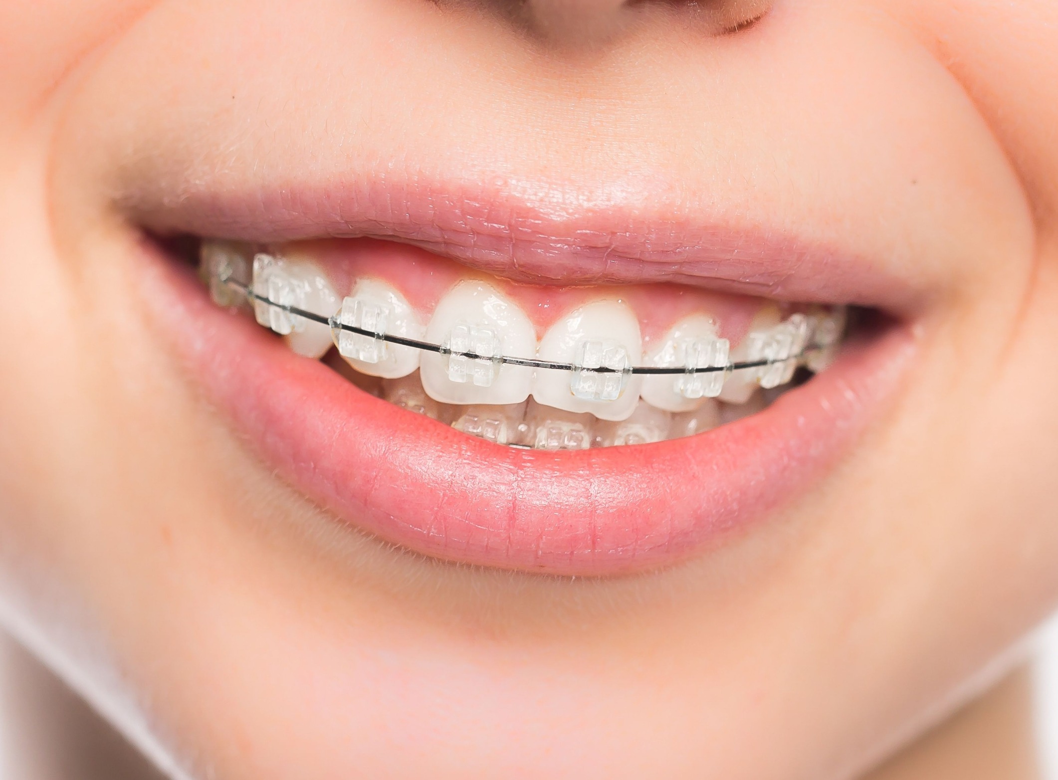 الحالات التي تصلح لعمل تقويم الأسنان