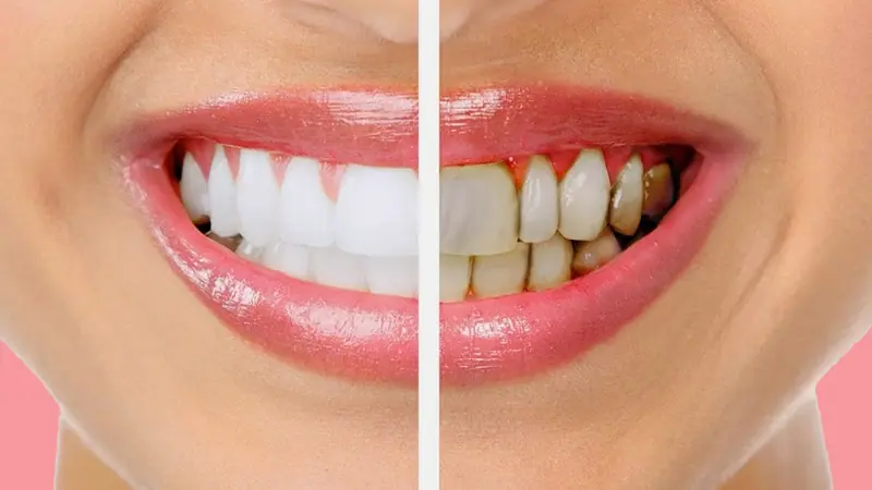 الطرق الحديثة لإزالة الجير وتنظيف الأسنان