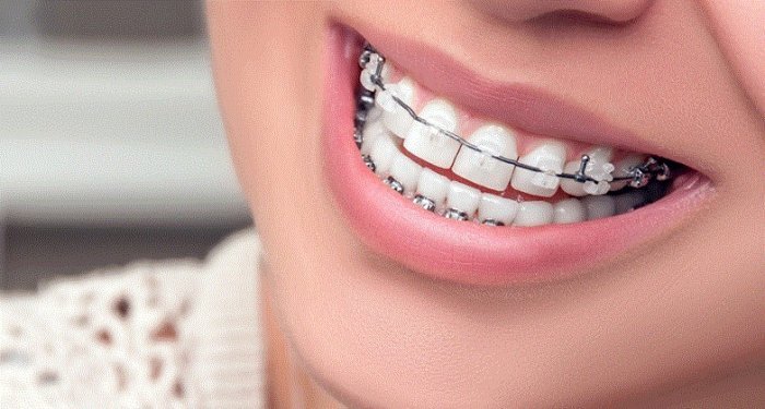 انواع تقويم اسنان مؤقت