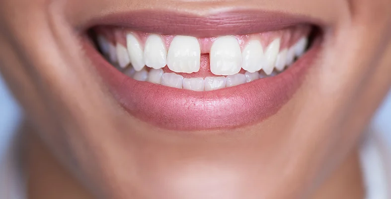 نصائح لتصفيف الاسنان في المنزل أثناء مرحلة ما قبل البلوغ