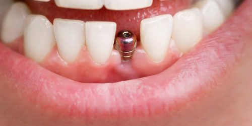 انواع تركيبات الاسنان الامامية