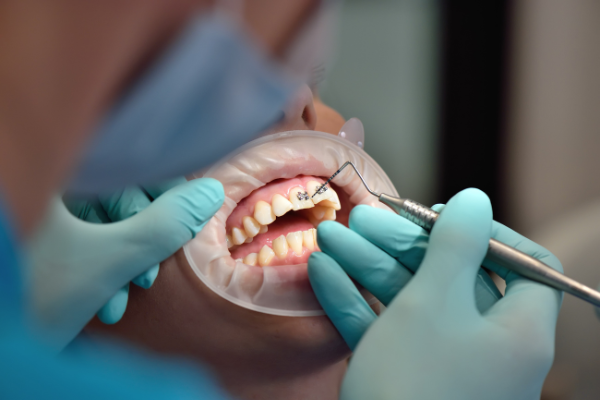 خطوات ومراحل تركيب تقويم الأسنان