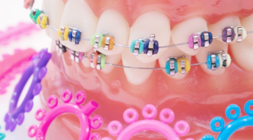 تعرف معنا على تقويم اسنان بريسز وما هي أبرز الأضرار المتوقعة منه؟