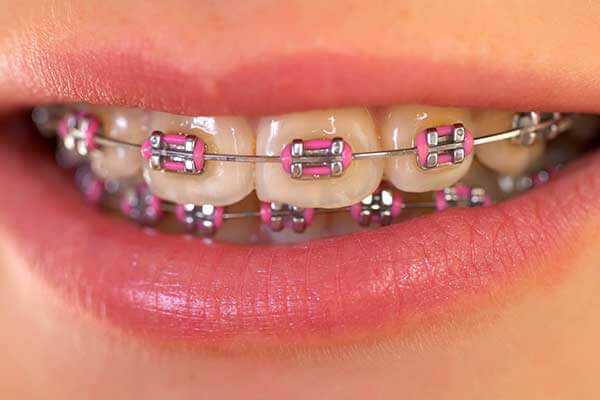 ما هي أنواع تقويم أسنان الفك العلوي؟