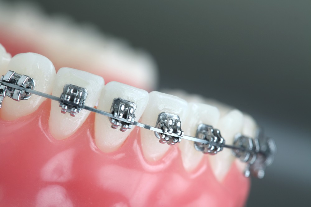 تعرف معنا على تركيب تقويم اسنان تحت والحالات التي تحتاج إليه!