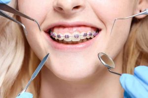 اكتشف أكثر عن تقويم اسنان عروض مميزة في المركز الطبي لرعاية الأسنان