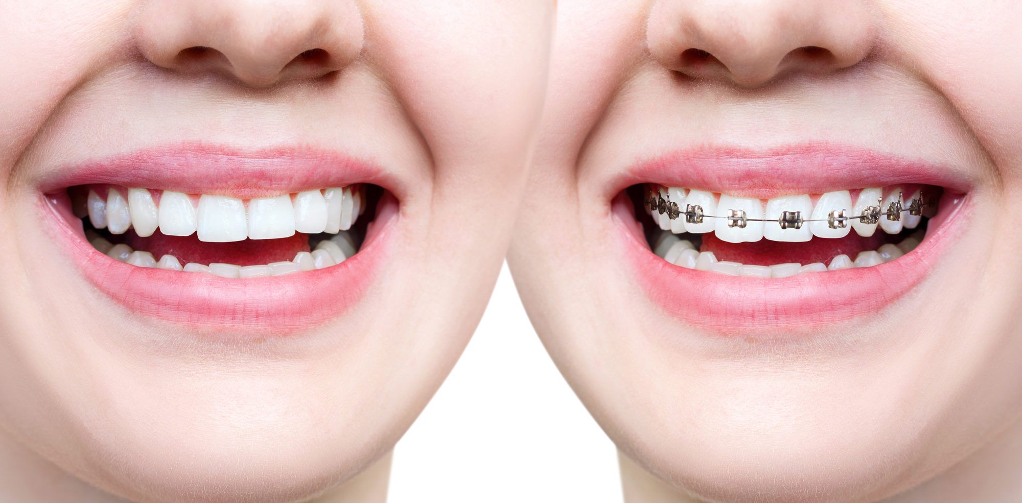 تقويم اسنان للفك العلوي فقط وما هي مدة تقويم الأسنان للفك العلوي؟