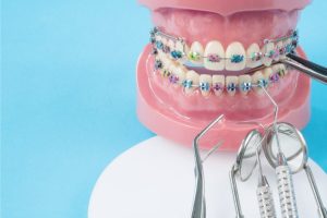 تعرف على تقويم اسنان مزيف والفرق بينه وبين التقويم الطبي!