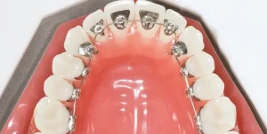 تعرف على تقويم الاسنان الداخلي الدائم وخطوات تركيبه!