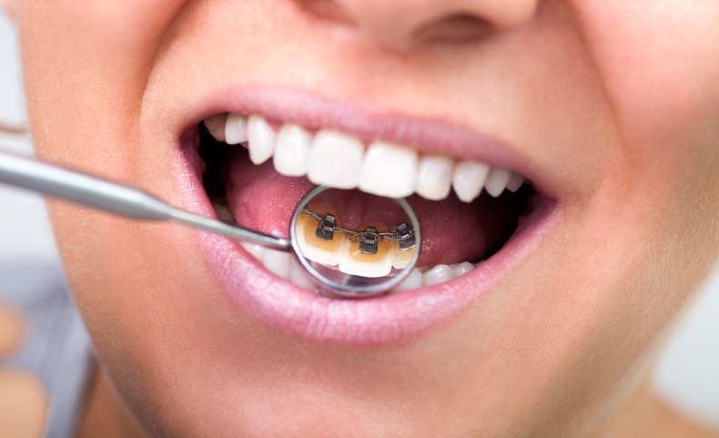 ما هو تقويم الاسنان الخلفي وهل يوجد له مزايا مختلفة؟