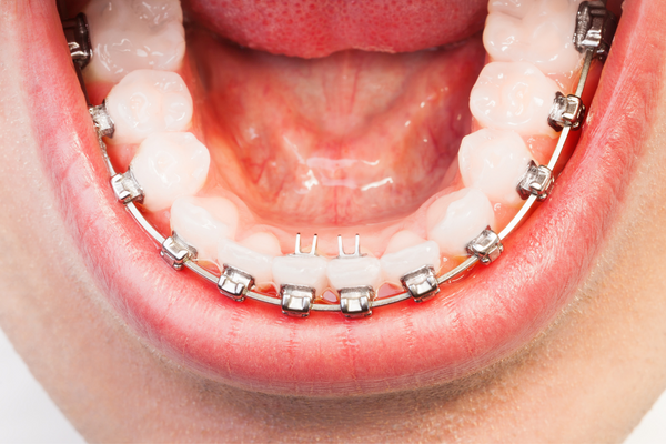 الحالات التي تتطلب تركيب تقويم أسنان الفك السفلي فقط
