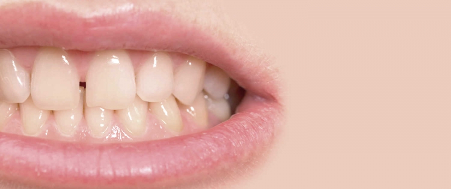 ما هو تقويم الاسنان المتباعدة والعمر الأمثل لتركيبه!