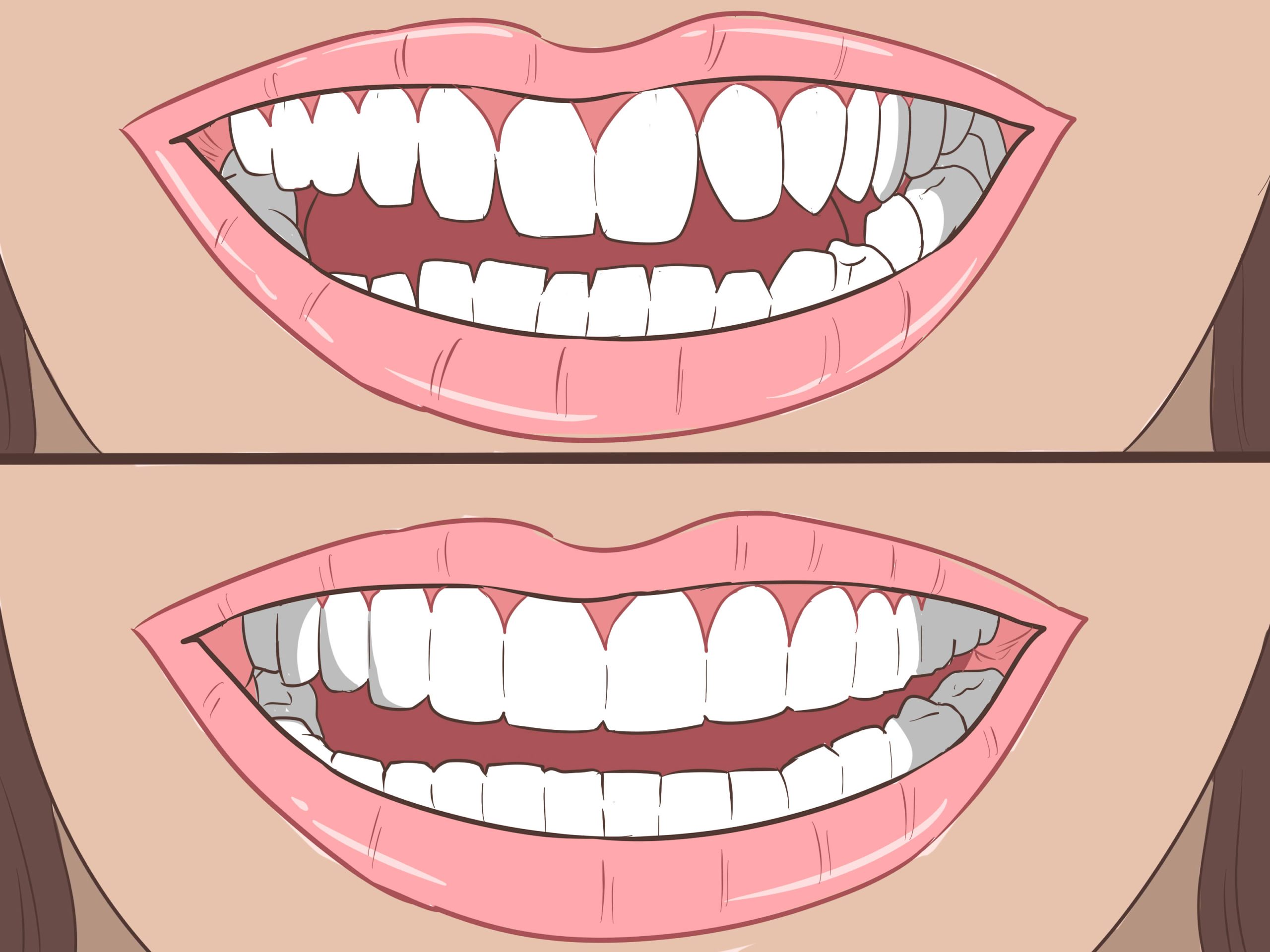 تعرف أكثر تقويم الاسنان طبيعيا وأهم مميزاته وهل يوجد له سلبيات أم لا؟