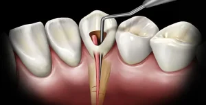 اكتشف علاج حشو العصب مؤلم باستخدام تقنية سحب عصب الأسنان بالليزر!