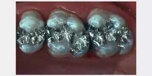 سمعت عن حشوات الاسنان المعدنية من قبل؟ وهل حقًا تسبب روائح كريهة في الفم أم لا؟