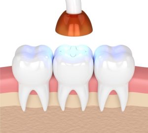 أهم المعلومات عن حشوات ضوئية تجميلية وكيفية تركيبها على الأسنان!